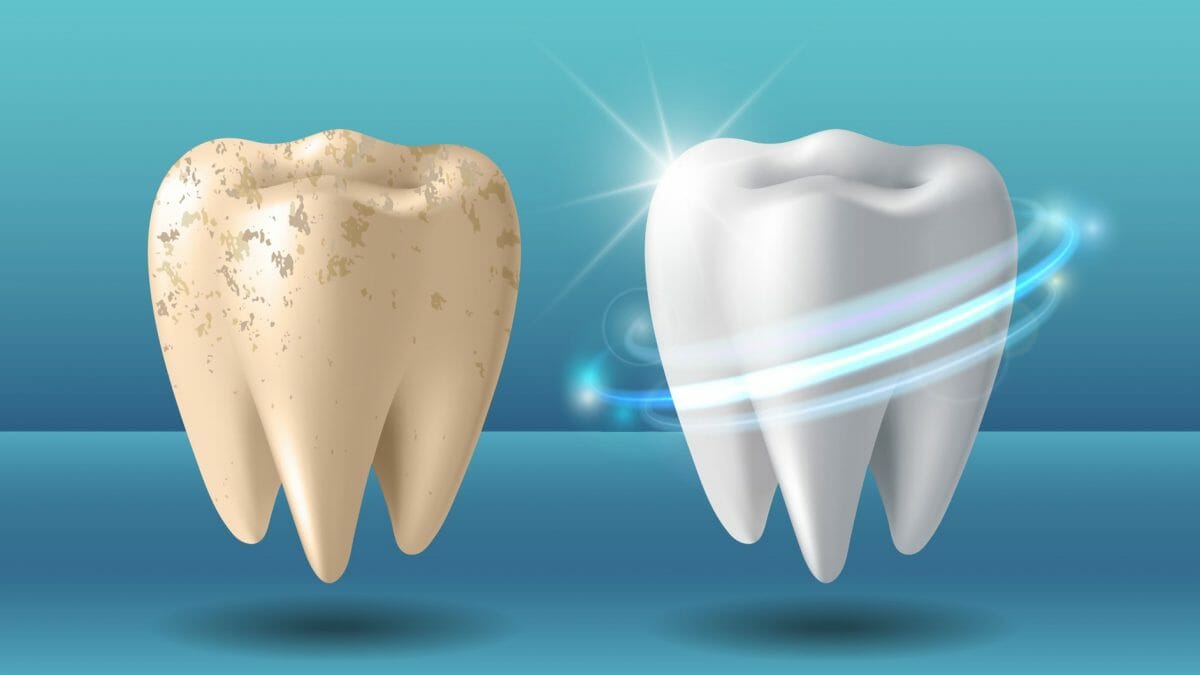 Teeth Whitening: Benefits Of That One Should Essentially Know About!