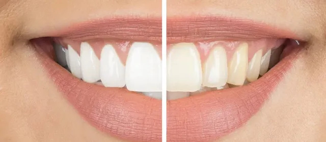 Teeth Whitening: Benefits Of That One Should Essentially Know About | Tower House Dental Clinic