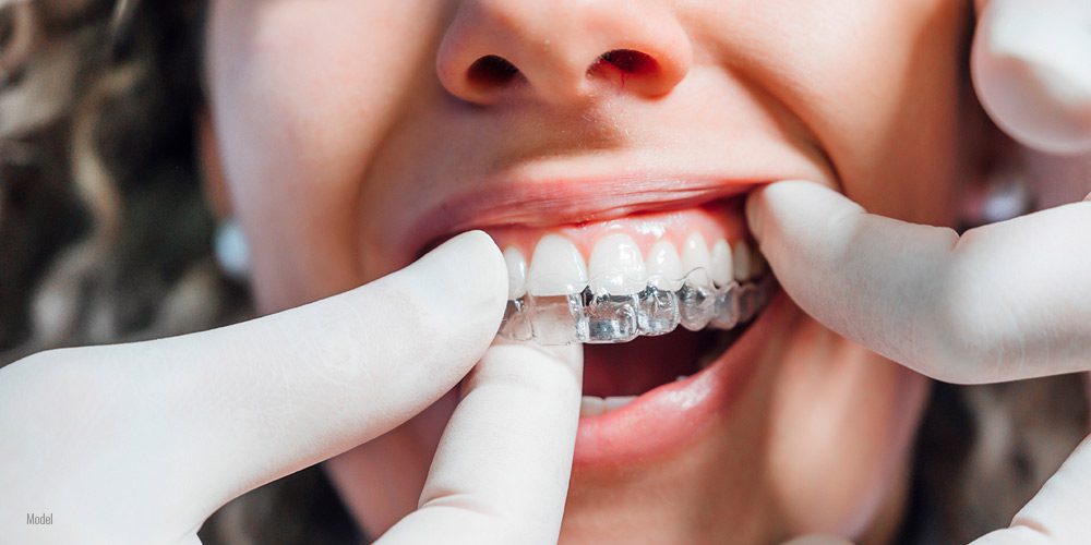 Invisalign provider in Encino