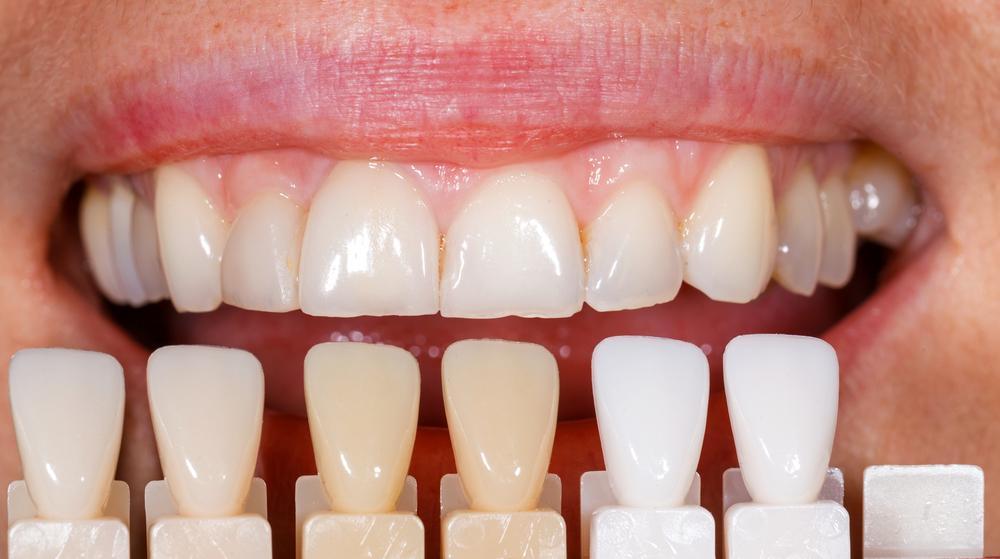 Porcelain Veneers 3